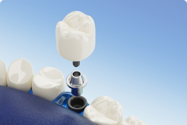 Dentalni implantati